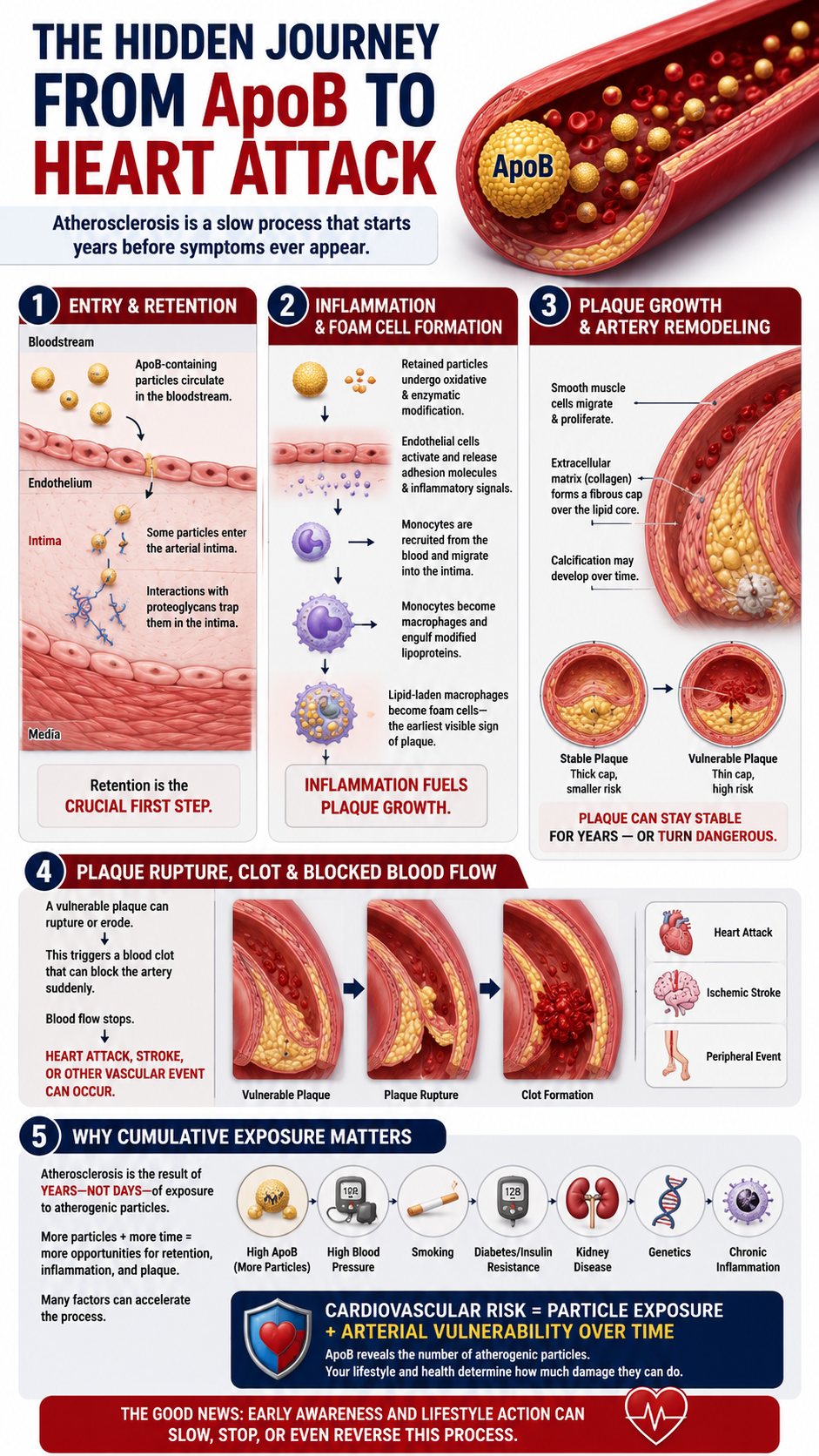 The Hidden Journey of Atherosclerosis