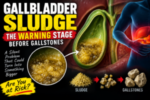 Gallbladder Sludge The Warning Stage